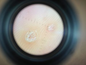 Verrucae viewed through a dermascope