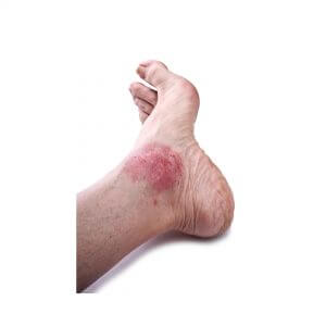 Psoriasis on the foot