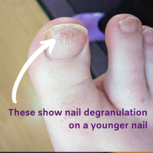 Degranulation on a toe nail