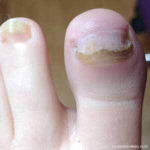 A big toe with nail fungus