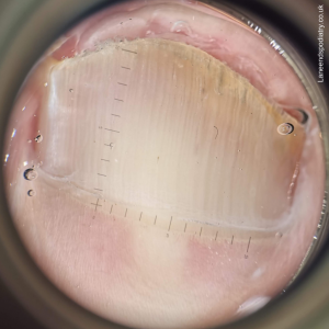Nail fungus viewed through a dermatoscope