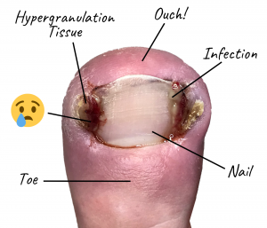 A graphic showing an ingrown toe nail