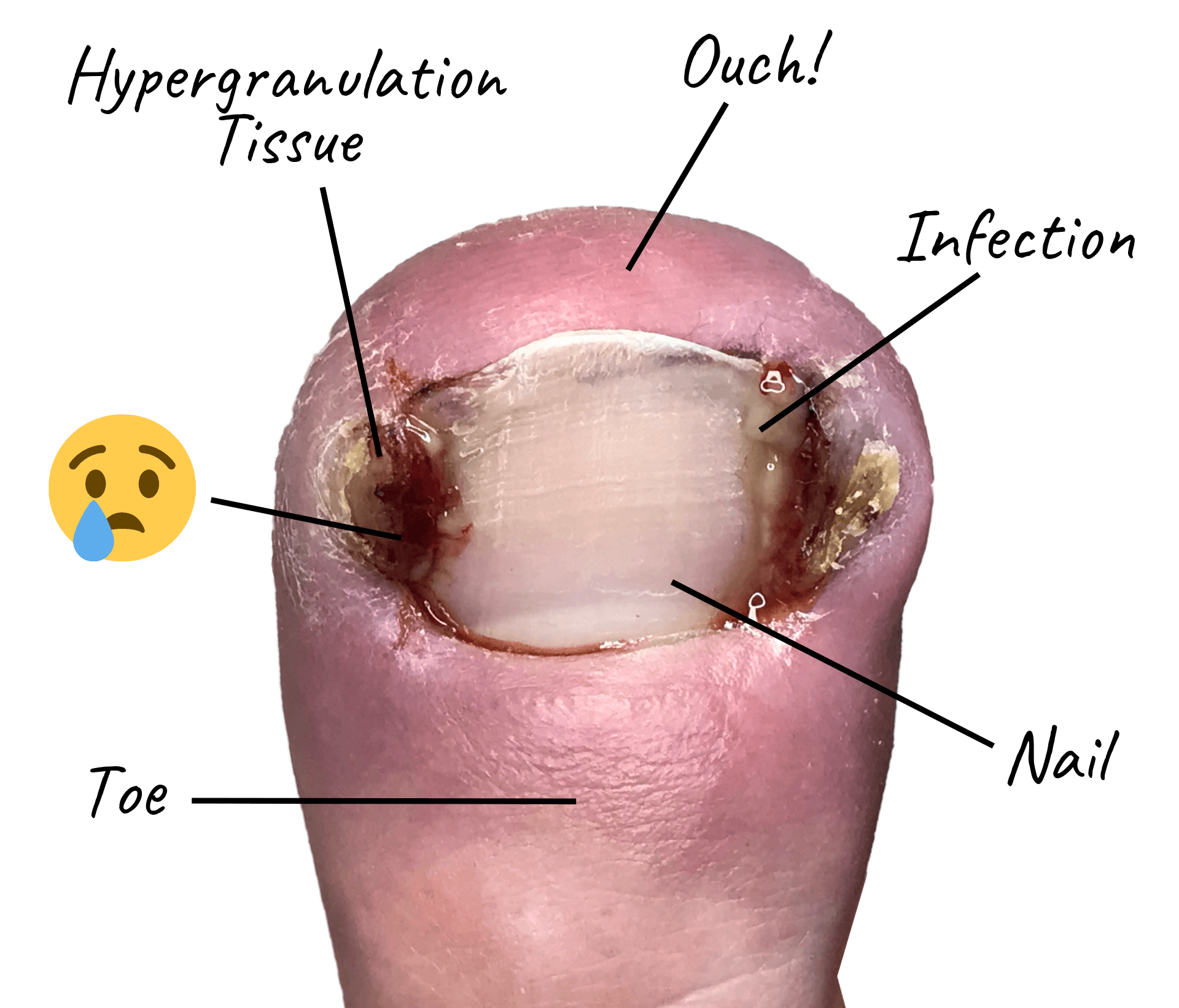 Ingrown Toe Nails Explained – Potty Purple Pod