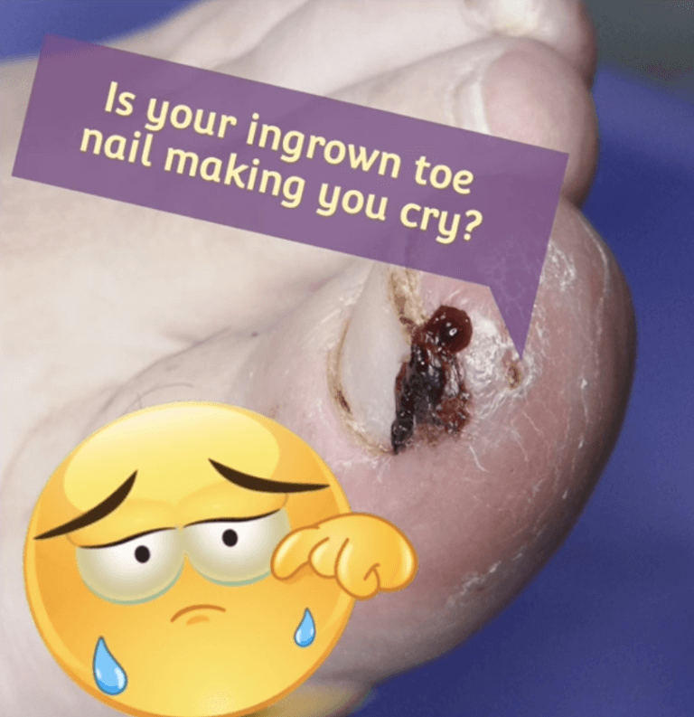 What is an Ingrown Toenail? Potty Purple Pod