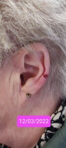 skin lesion on ear