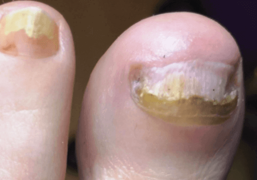 A big toe with nail fungus