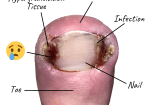A graphic showing an ingrown toe nail