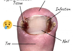 Podiatry Warrington - Potty Purple Pod at Lane Ends Podiatry